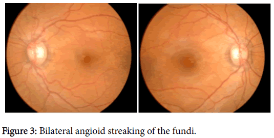 Clinical Experimental Dermatology Bilateral Angioid Clinical Experimental Dermatology Bilateral Angioid