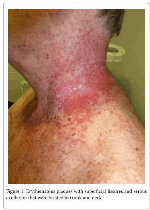 Experimental Dermatology Erythematous Plaques Experimental Dermatology Erythematous Plaques