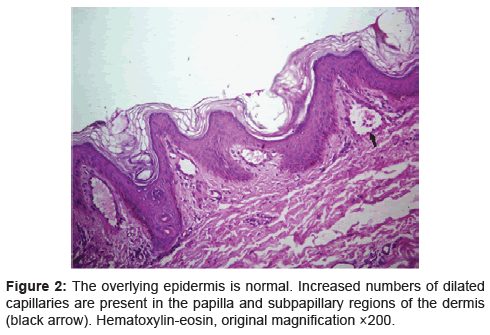 Angioma Serpiginosum | OMICS International