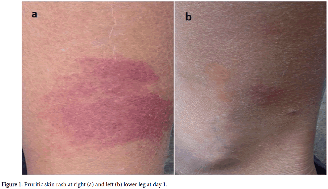 Allopurinol mechanism of action in gout look like