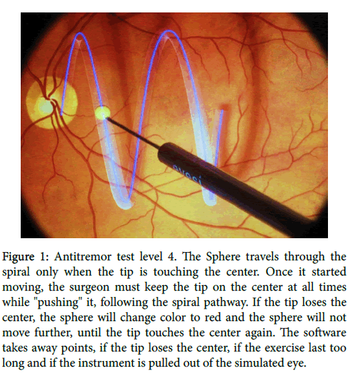 clinical-experimental-ophthalmology-Antitremor-test-level