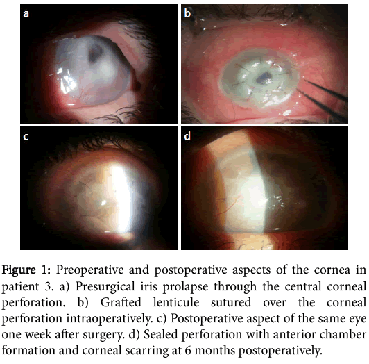 Clinical Experimental Ophthalmology Preoperative Postoperative Aspects Clinical Experimental Ophthalmology Preoperative Postoperative Aspects