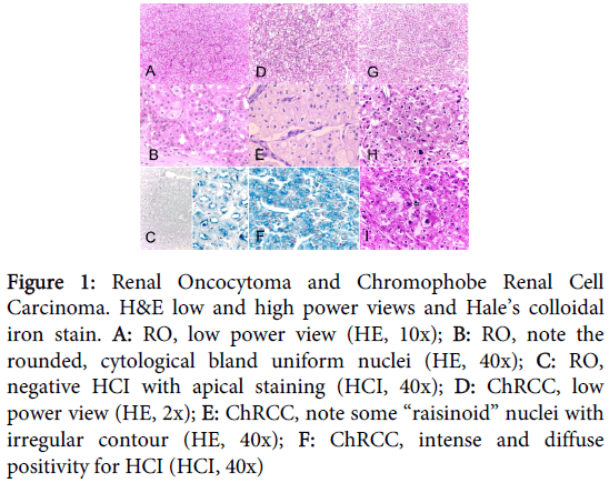 clinical-experimental-pathology-Chromophobe-Renal-Cell