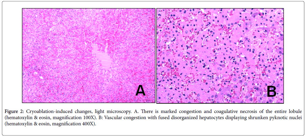 clinical-experimental-pathology-Cryoablation-induced