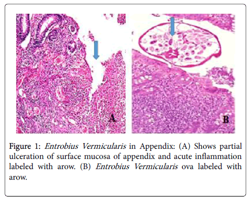 clinical-experimental-pathology-Entrobius-Vermicularis