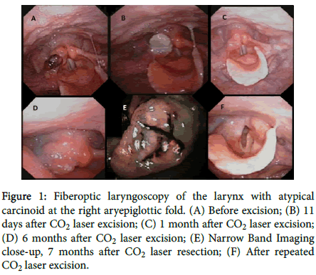 clinical-experimental-pathology-Fiberoptic-laryngoscopy