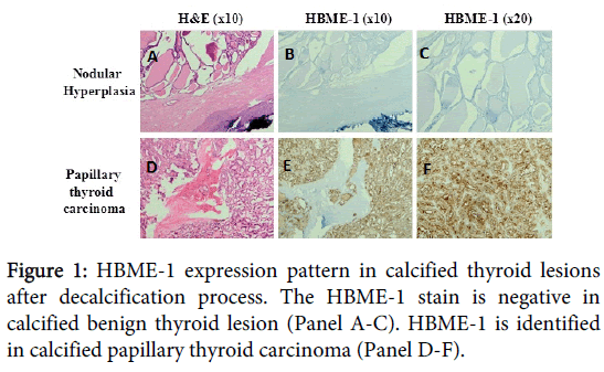 clinical-experimental-pathology-HBME-1-expression-pattern