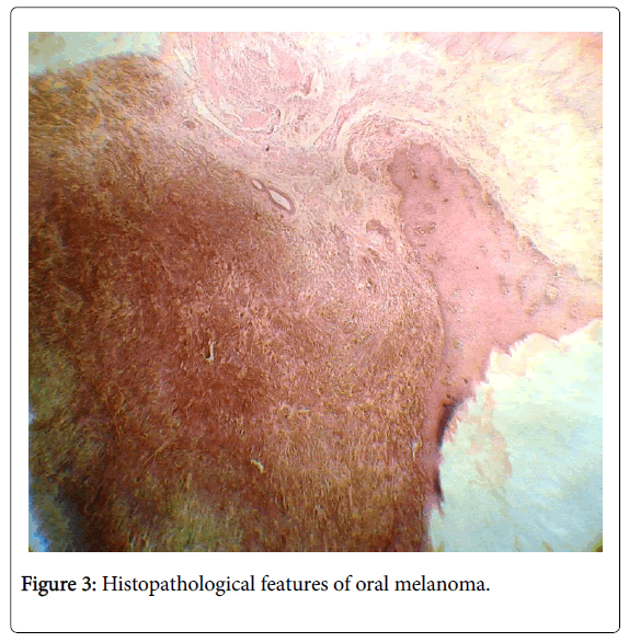 clinical presentation of oral malignant melanoma