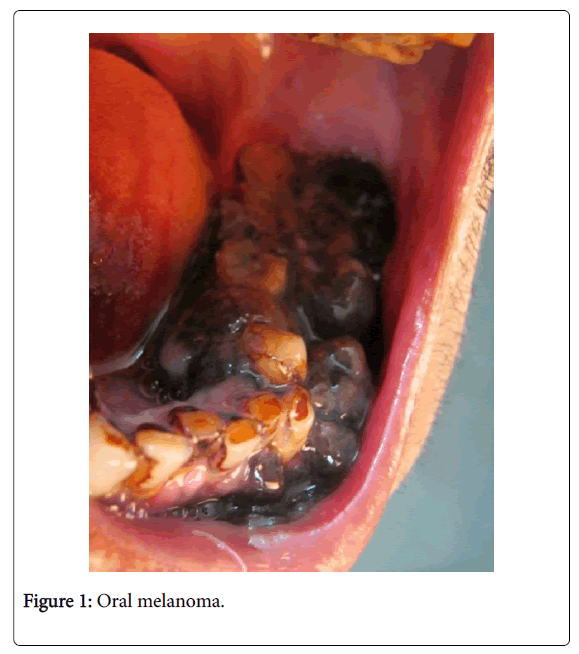 clinical-experimental-pathology-Oral-melanoma