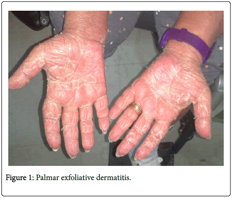 clinical-experimental-pathology-Palmar-exfoliative-dermatitis