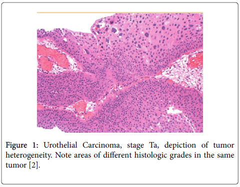 clinical-experimental-pathology-Urothelial-Carcinoma