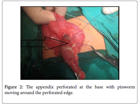 clinical-experimental-pathology-appendix-perforated