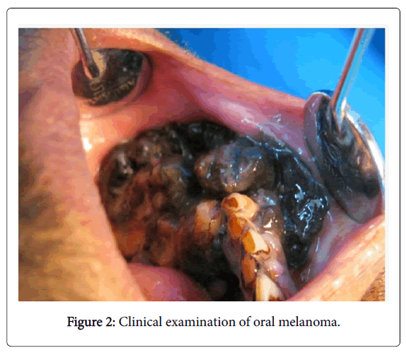 clinical-experimental-pathology-examination-oral-melanoma