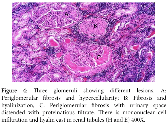 clinical-experimental-pathology-hyalin-cast-renal-tubules