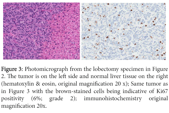 clinical-experimental-pathology-lobectomy-specimen