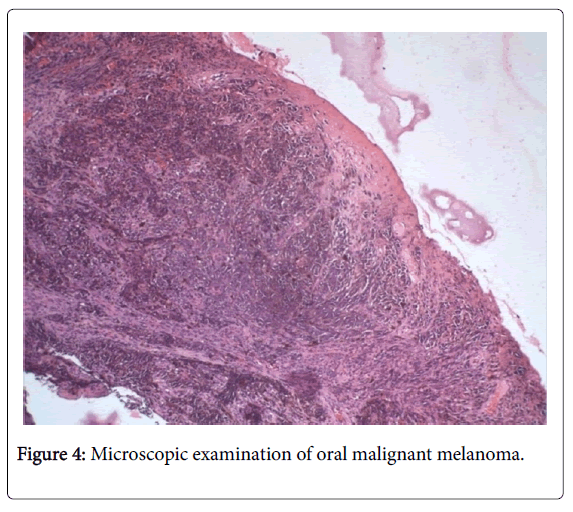 clinical-experimental-pathology-oral-malignant-melanoma