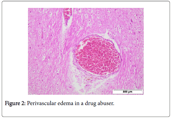 clinical-experimental-pathology-perivascular-edema