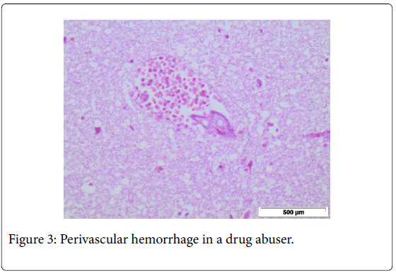 clinical-experimental-pathology-perivascular-hemorrhage