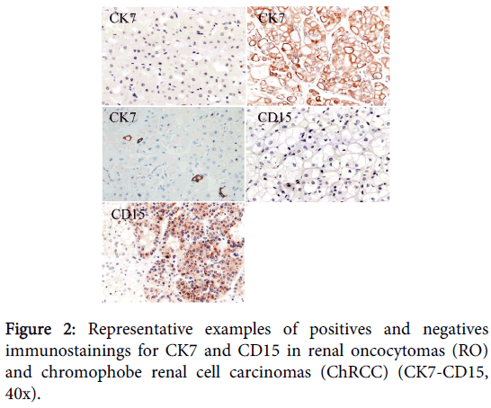 clinical-experimental-pathology-renal-cell-carcinomas