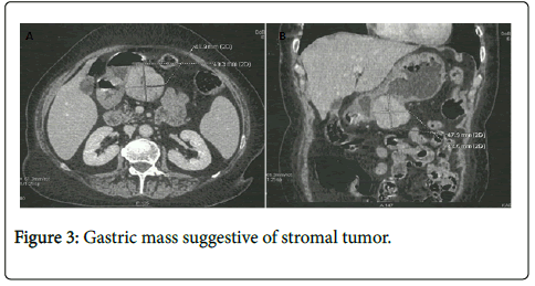 clinical-experimental-pathology-stromal-tumor
