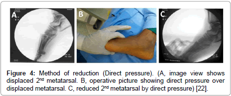 clinical-foot-ankle-Direct-pressure