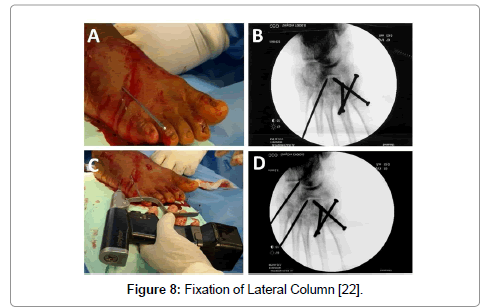 clinical-foot-ankle-Lateral-Column