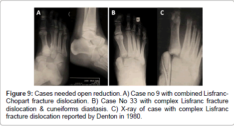 clinical-foot-ankle-Lisfranc-fracture