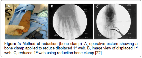 clinical-foot-ankle-bone-clamp