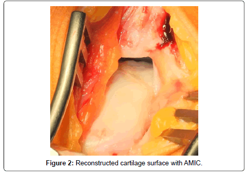clinical-foot-ankle-cartilage-surface