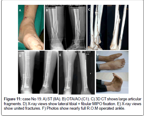 clinical-foot-ankle-large-fractures