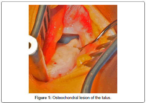 clinical-foot-ankle-lesion-talus