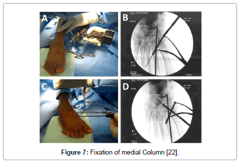 clinical-foot-ankle-medial-Column