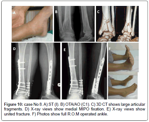 clinical-foot-ankle-medial-fixation