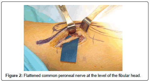 clinical-foot-ankle-peroneal-nerve