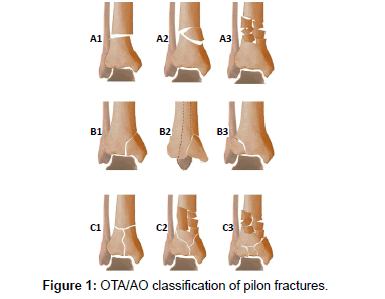 clinical-foot-ankle-pilon-fractures