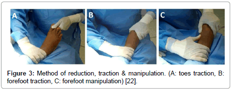 clinical-foot-ankle-reduction-traction