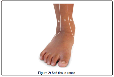 clinical-foot-ankle-tissue-zones