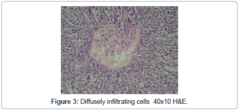 clinical-pathology-Diffusely-infiltrating-cells