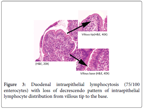 clinical-pathology-Duodenal-intraepithelial