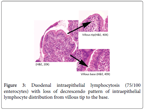 H Pylori Weight Loss Case Report Journals