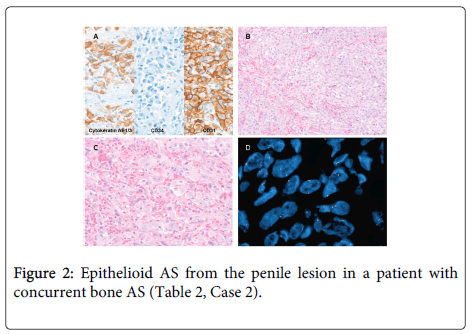 clinical-pathology-Epithelioid-AS-from