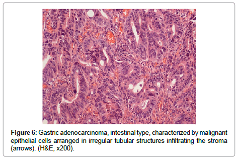 clinical-pathology-Gastric-adenocarcinoma