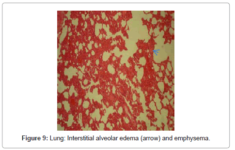 clinical-pathology-Interstitial-alveolar