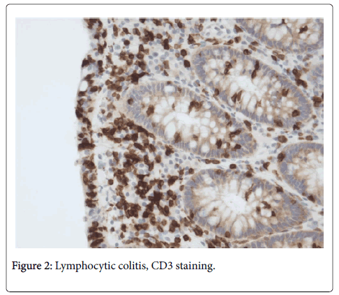 clinical-pathology-Lymphocytic-colitis