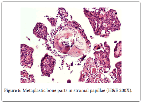 clinical-pathology-Metaplastic-bone-parts