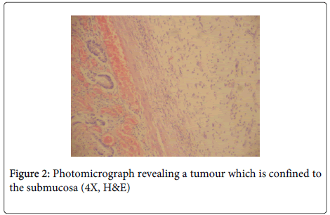 clinical-pathology-Photomicrograph-tumour