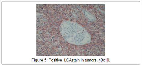 clinical-pathology-Positive-LCAstain