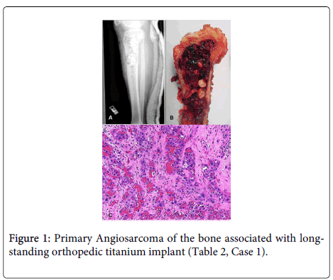 clinical-pathology-Primary-Angiosarcoma