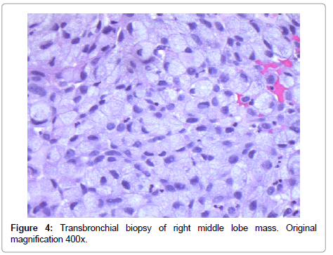 Full article: An updated review on primary signet-ring cell carcinoma of  the urinary bladder and report of a case