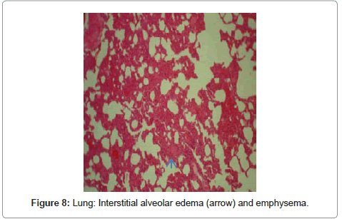 clinical-pathology-alveolar-emphysema